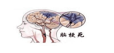 8.卒中识别早,救治效果好 4.22-4.28神经内科一区222.png 8.卒中识别早,救治效果好 4.22-4.28神经内科一区222.png