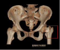 18.“髋”心面对“人生最后一次”-股骨转子间骨折14W创骨6.3-6.9424.png