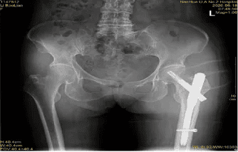 18.“髋”心面对“人生最后一次”-股骨转子间骨折14W创骨6.3-6.9758.png 18.“髋”心面对“人生最后一次”-股骨转子间骨折14W创骨6.3-6.9758.png