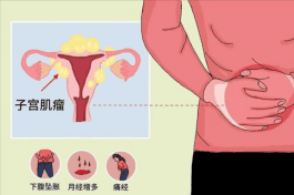 17.关于子宫肌瘤的那些事 13W妇科5.27-6.2331.png